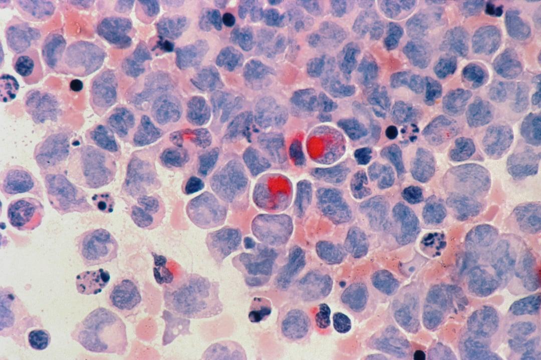personalised medicine offers improved cancer detection